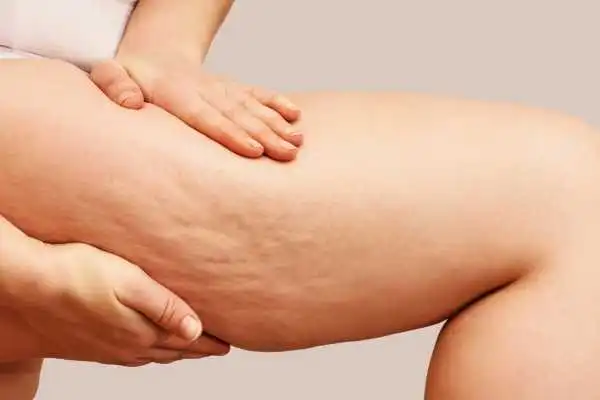 Image of woman showing leg with cellulite Shepperton Green
