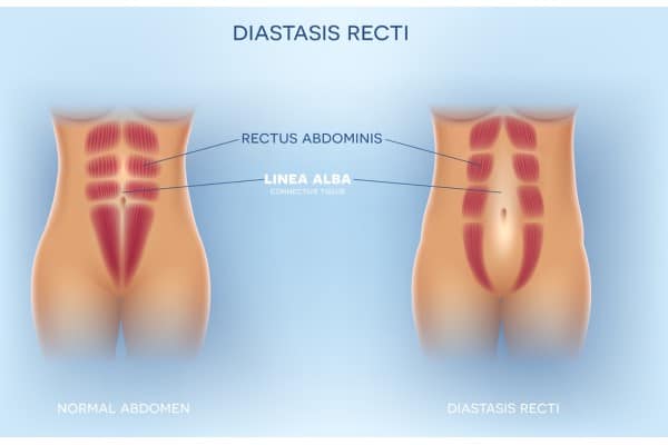 What Non-Surgical Options Are Available for Diastasis Recti Shepperton Green?
