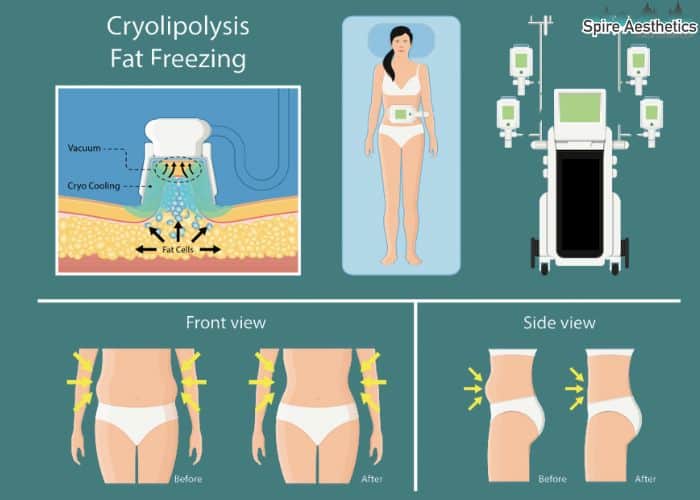 Image of diet and fat freezing combined for best results for Spire Aesthetics Shepperton Green