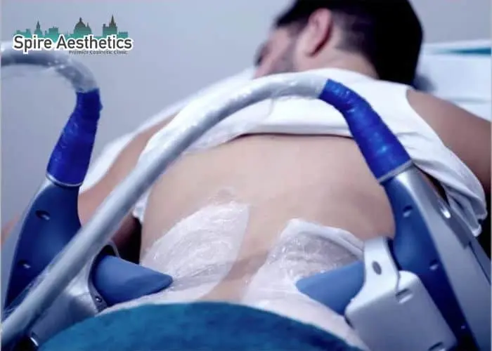 Man having fat freezing treatment done on love handles before a competitions Shepperton Green to create a sculpted look.