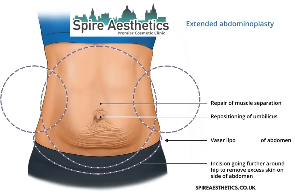 Understanding Loose Skin After Gastric Band Shepperton Green Surgery and HIFU Treatment 