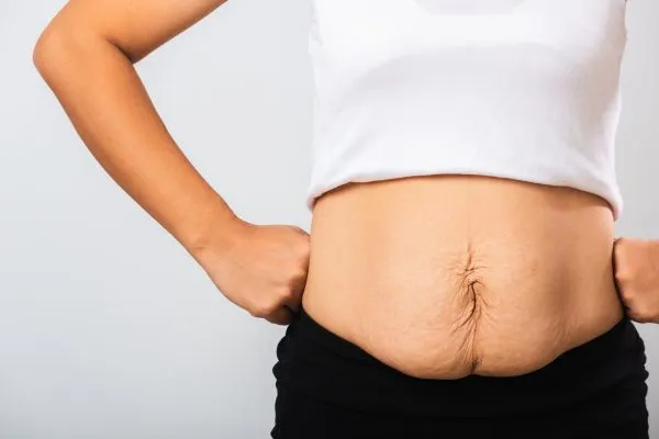 Image of a woman's stomach after weight loss with sagging skin following a gastric band Shepperton Green