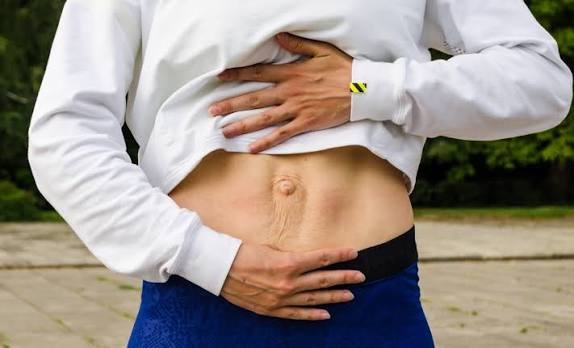 When Could Diastasis Recti Be the Missing Piece of the Puzzle Shepperton Green?