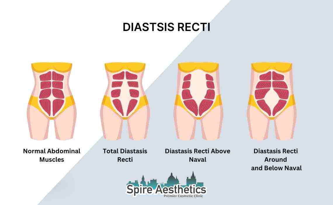 Is Non-Surgical Diastasis Recti Treatment Right for You? Common Concerns Answered Shepperton Green